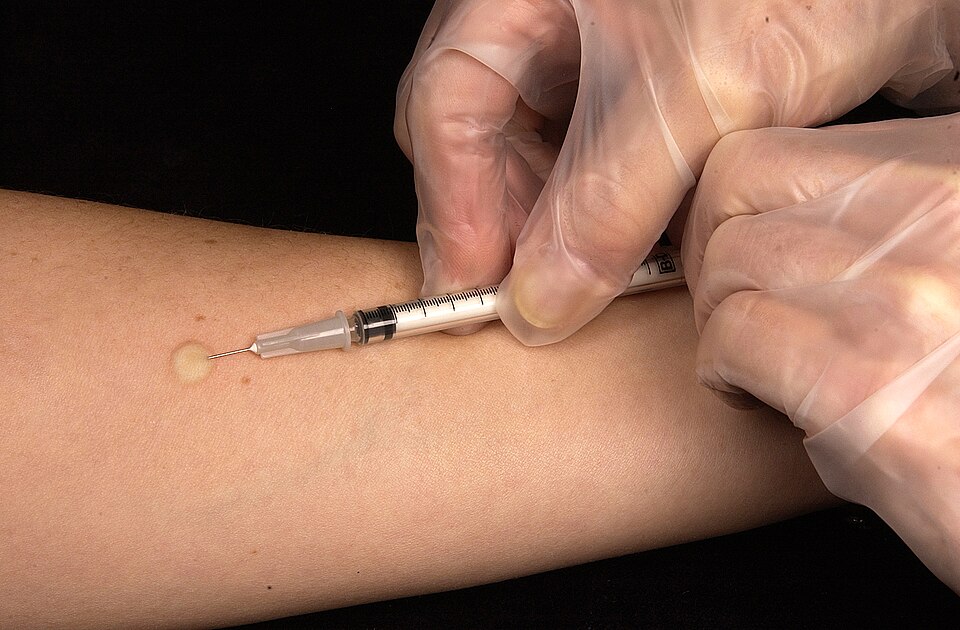 Intradermal injection creating a dermal wheal