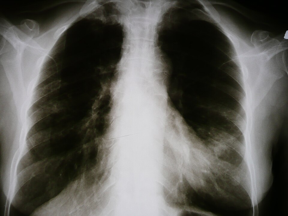Rheumatoid Arthritis clinical reference photography