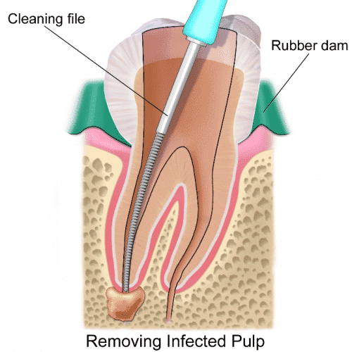 Illustration of a tooth and its internal root canal anatomy