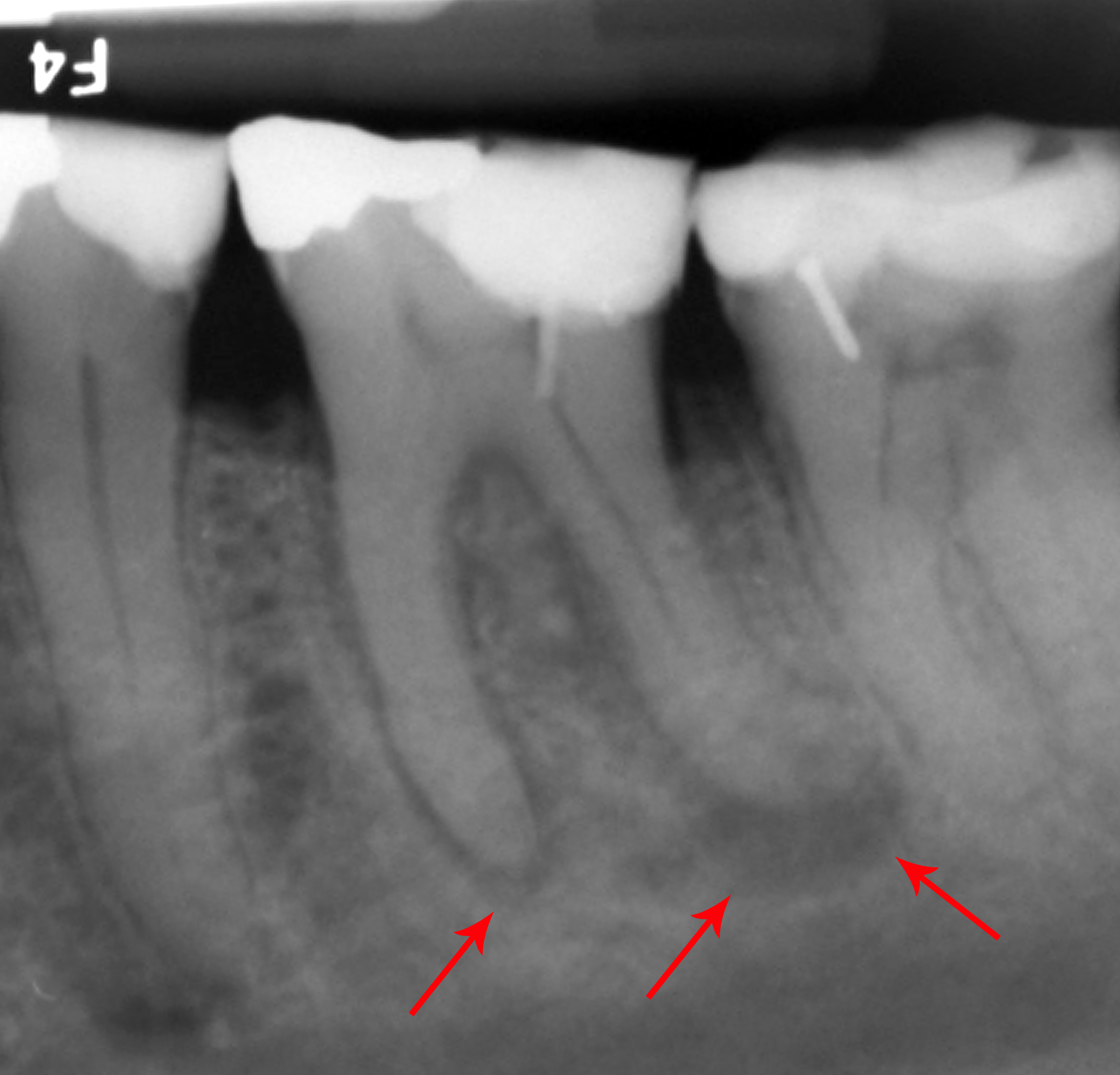 Digital periapical dental radiograph displaying apex bone loss and root canal anatomy